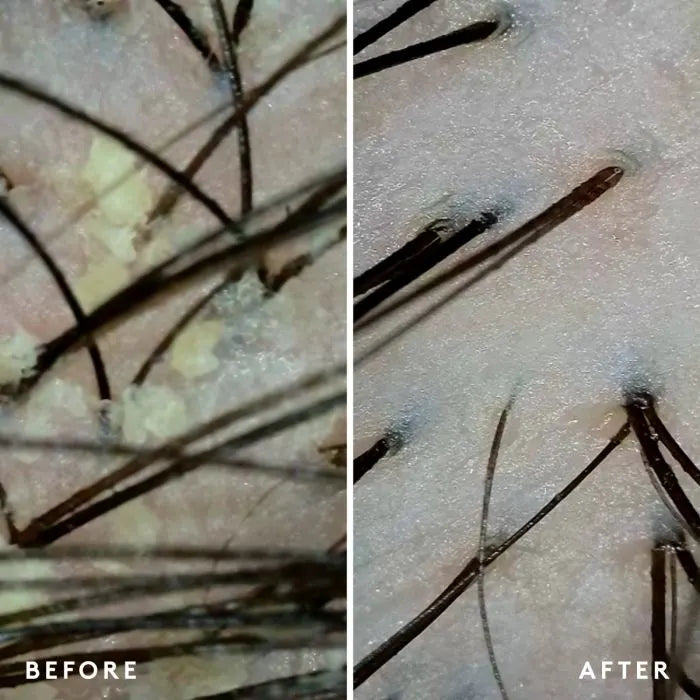 Exfoliating Scalp Treatment